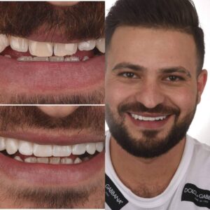 מהפכת ציפויי שיניים ב-Calla Smile Suite- ציפוי חרסינה לשיניים בשני מפגשים. לפני ואחרי