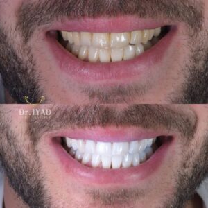 מהפכת הלבנת שיניים ב-Calla Smile Suite- הלבנת שיניים בשיטת ננוטכנולוגיה של ד''ר איאד חסן - לפני ואחרי