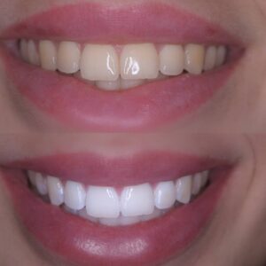 מהפכת הלבנת שיניים ב-Calla Smile Suite- הלבנת שיניים בשיטת ננוטכנולוגיה של ד''ר איאד חסן - לפני ואחרי