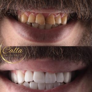 מהפכת ציפויי שיניים ב-Calla Smile Suite- ציפוי חרסינה לשיניים בשני מפגשים. לפני ואחרי