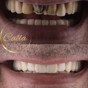 מהפכת ציפויי שיניים ב-Calla Smile Suite- ציפוי חרסינה לשיניים בשני מפגשים. לפני ואחרי