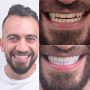 מהפכת ציפויי שיניים ב-Calla Smile Suite- ציפוי חרסינה לשיניים בשני מפגשים. לפני ואחרי